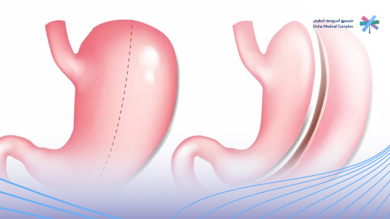 علاج-السمنة-المفرطة علاج-السمنة-المفرطة
