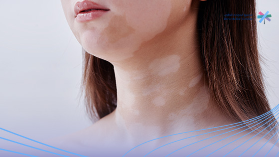 أسباب-البهاق-المفاجئ أسباب-البهاق-المفاجئ
