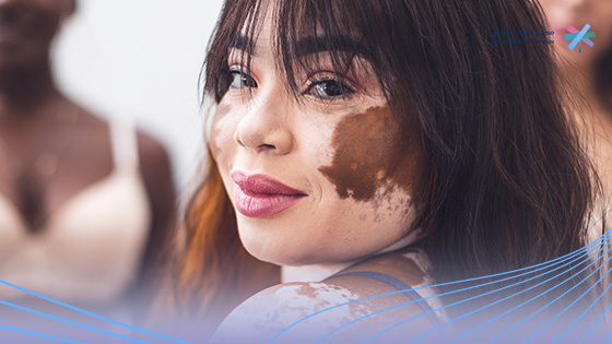 أنواع-البهاق أنواع-البهاق