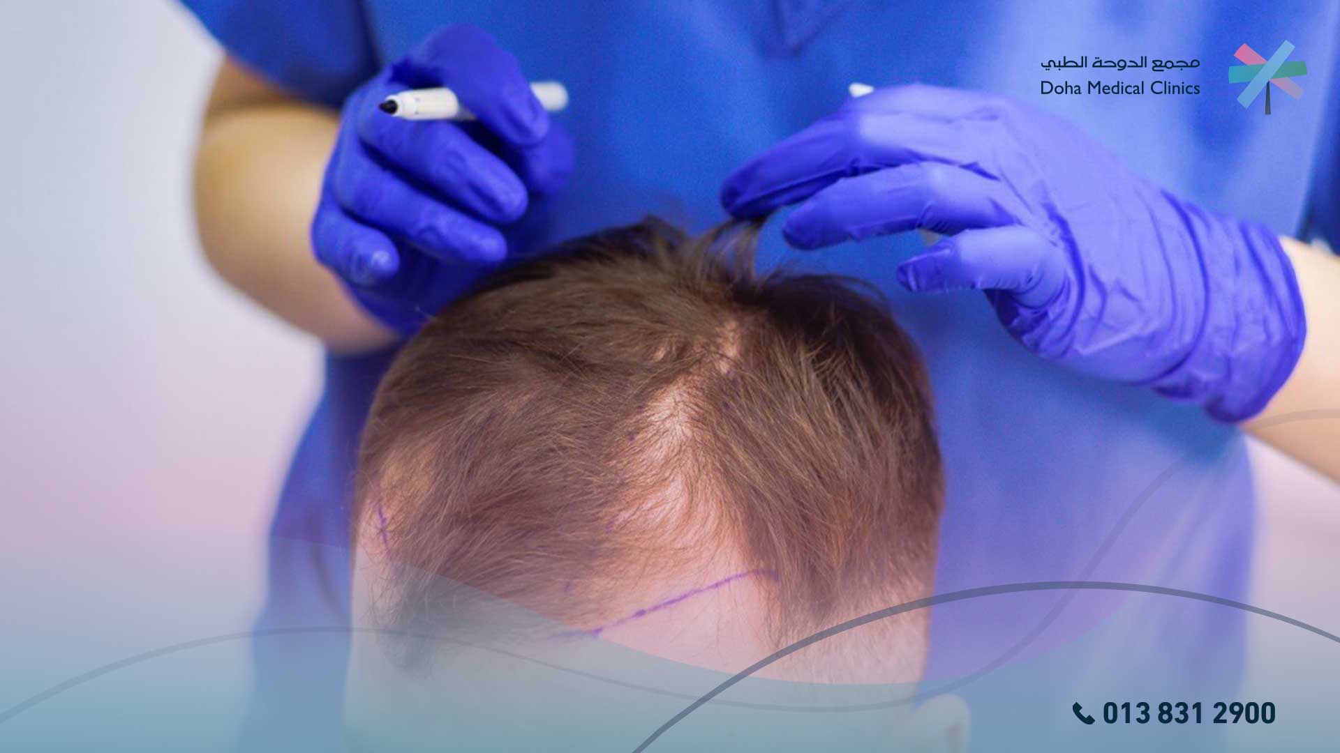زراعة الشعر