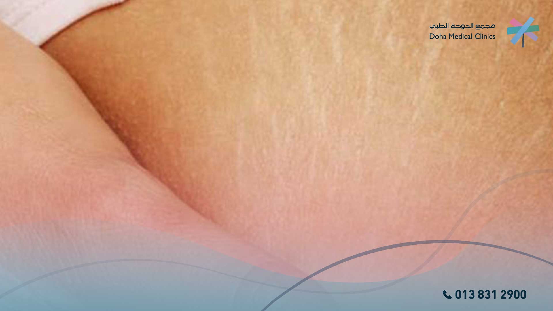 تشققات حمراء