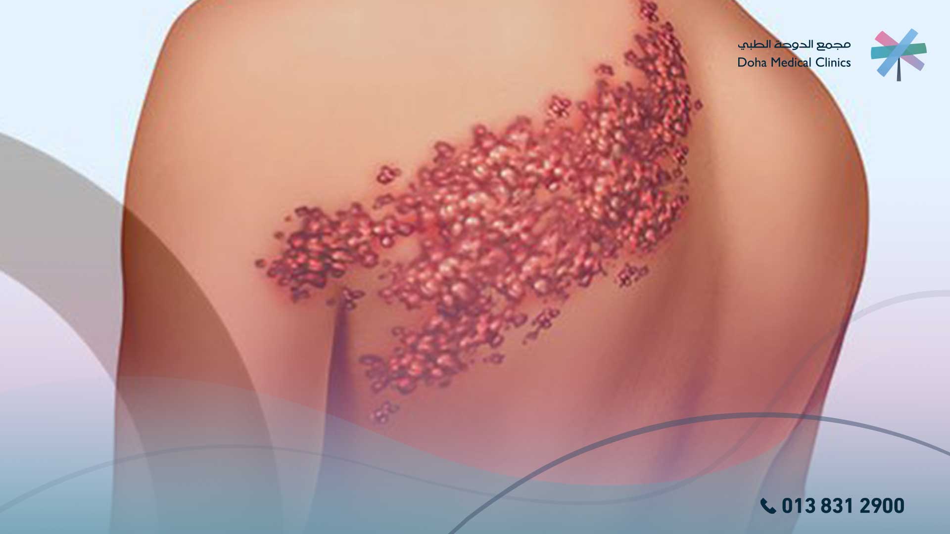 علاج الحزام الناري