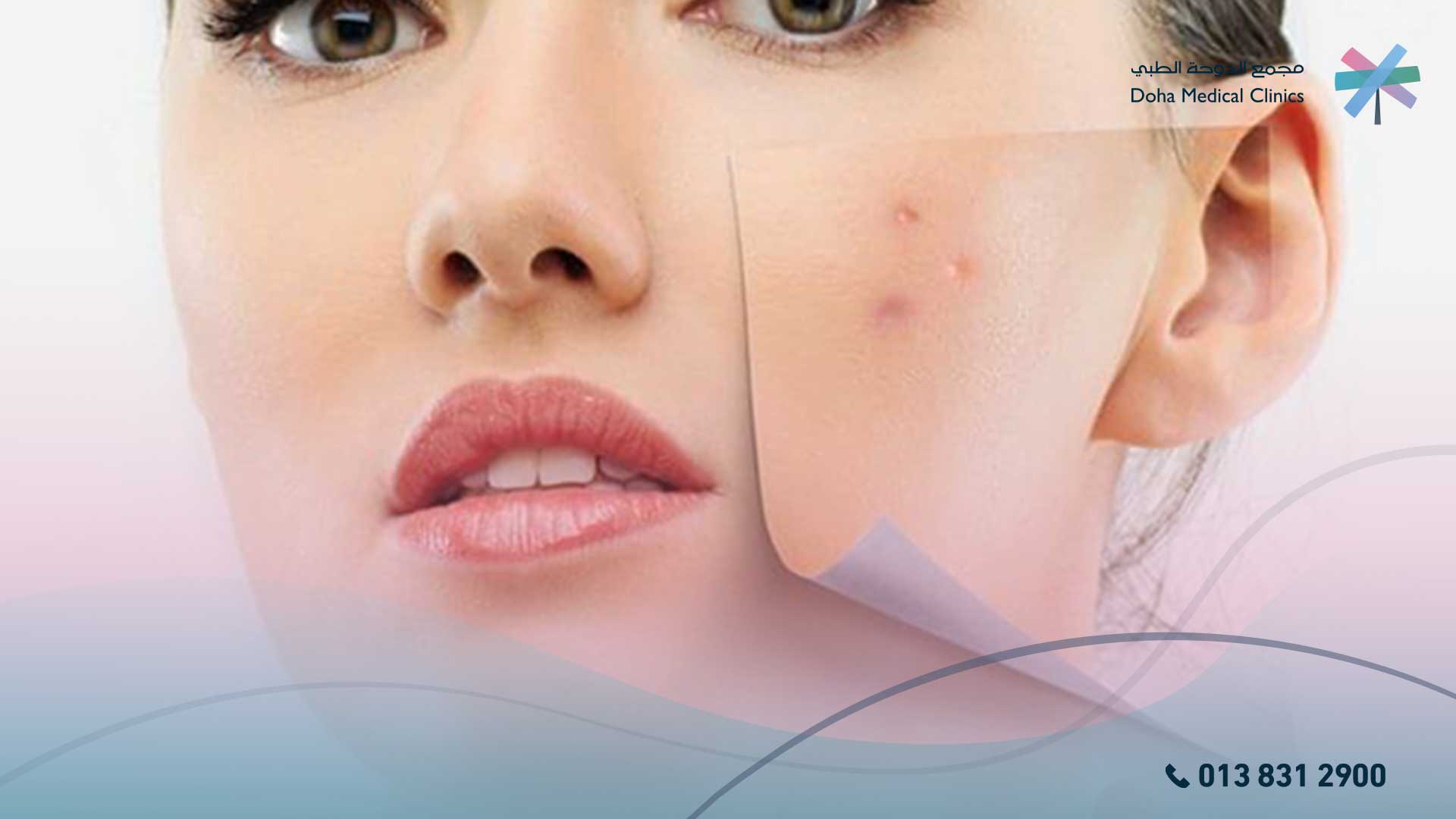اسباب ظهور حب الشباب