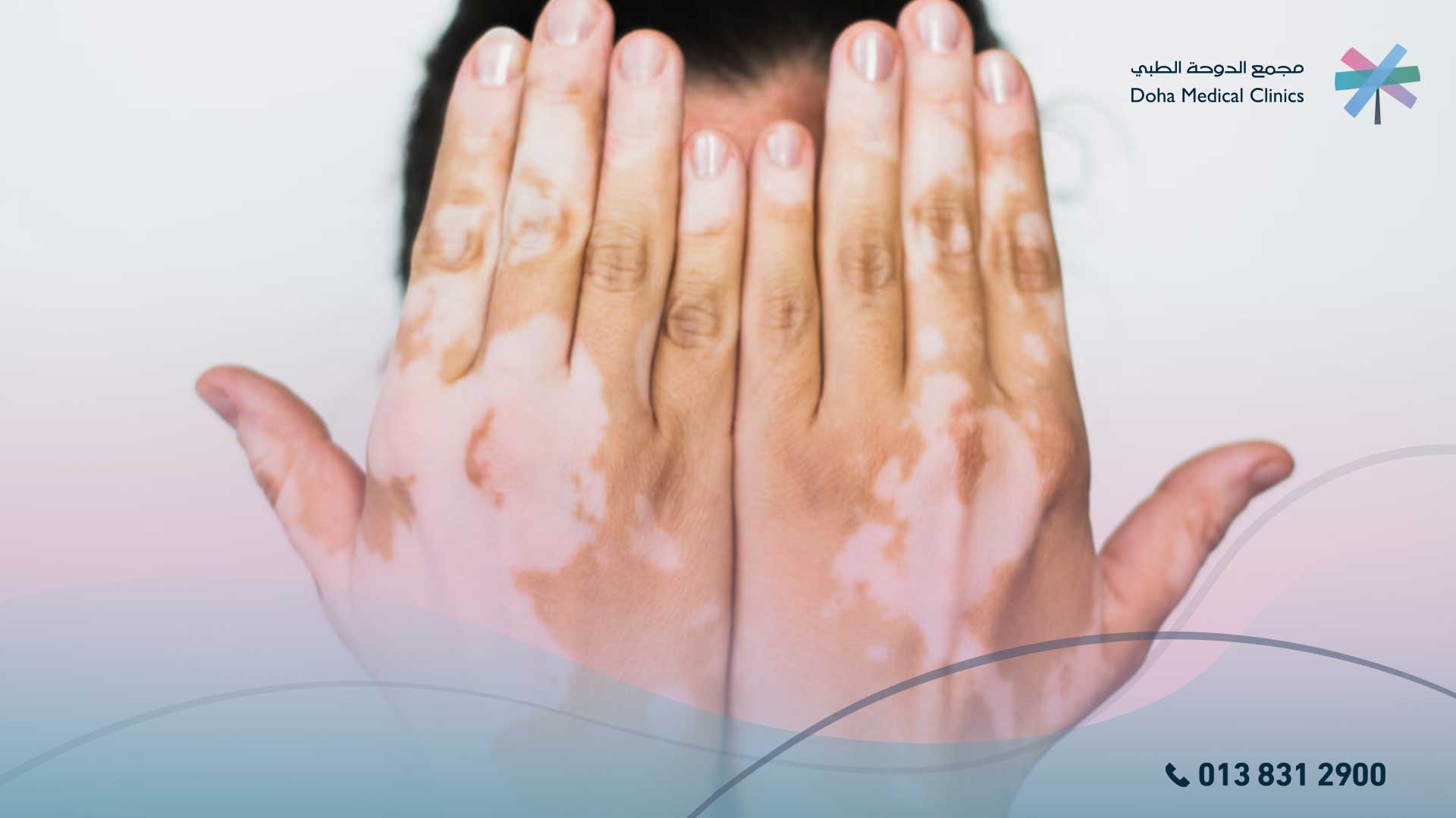 بداية ظهور البهاق
