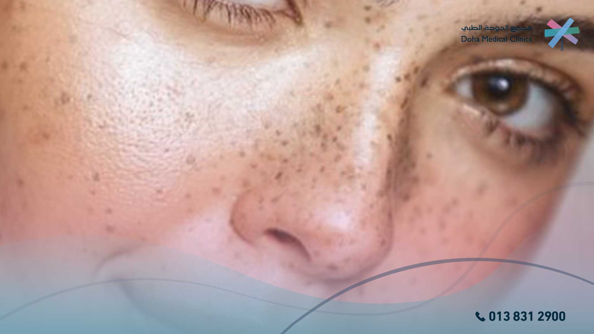 علاج فرط التصبغ