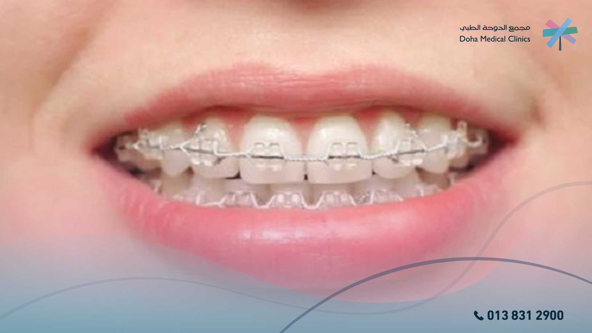 تقويم الأسنان التجميلي
