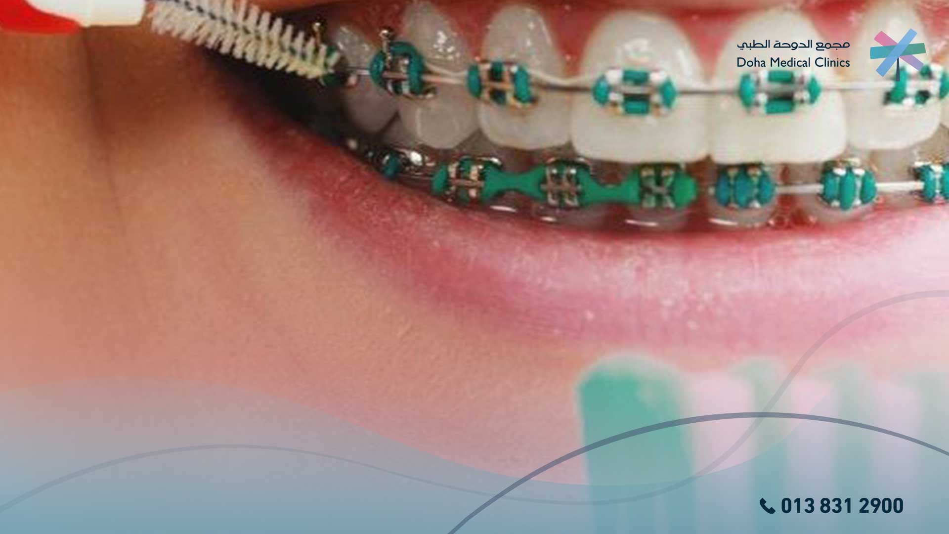 تنظيف الأسنان من الجير أثناء التقويم