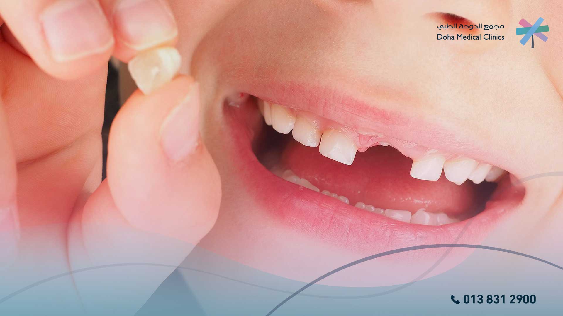 ظهور الأسنان الدائمة خلف اللبنية