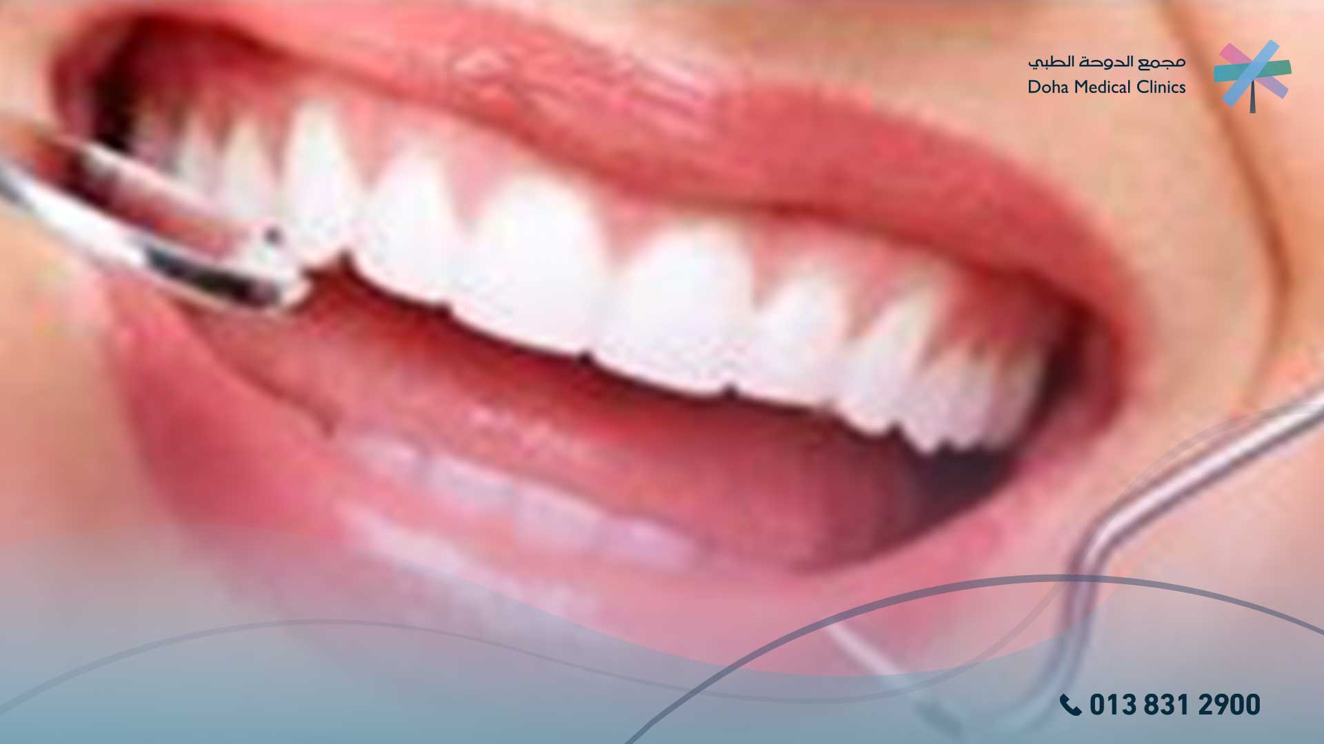 تركيبه اسنان مؤقته
