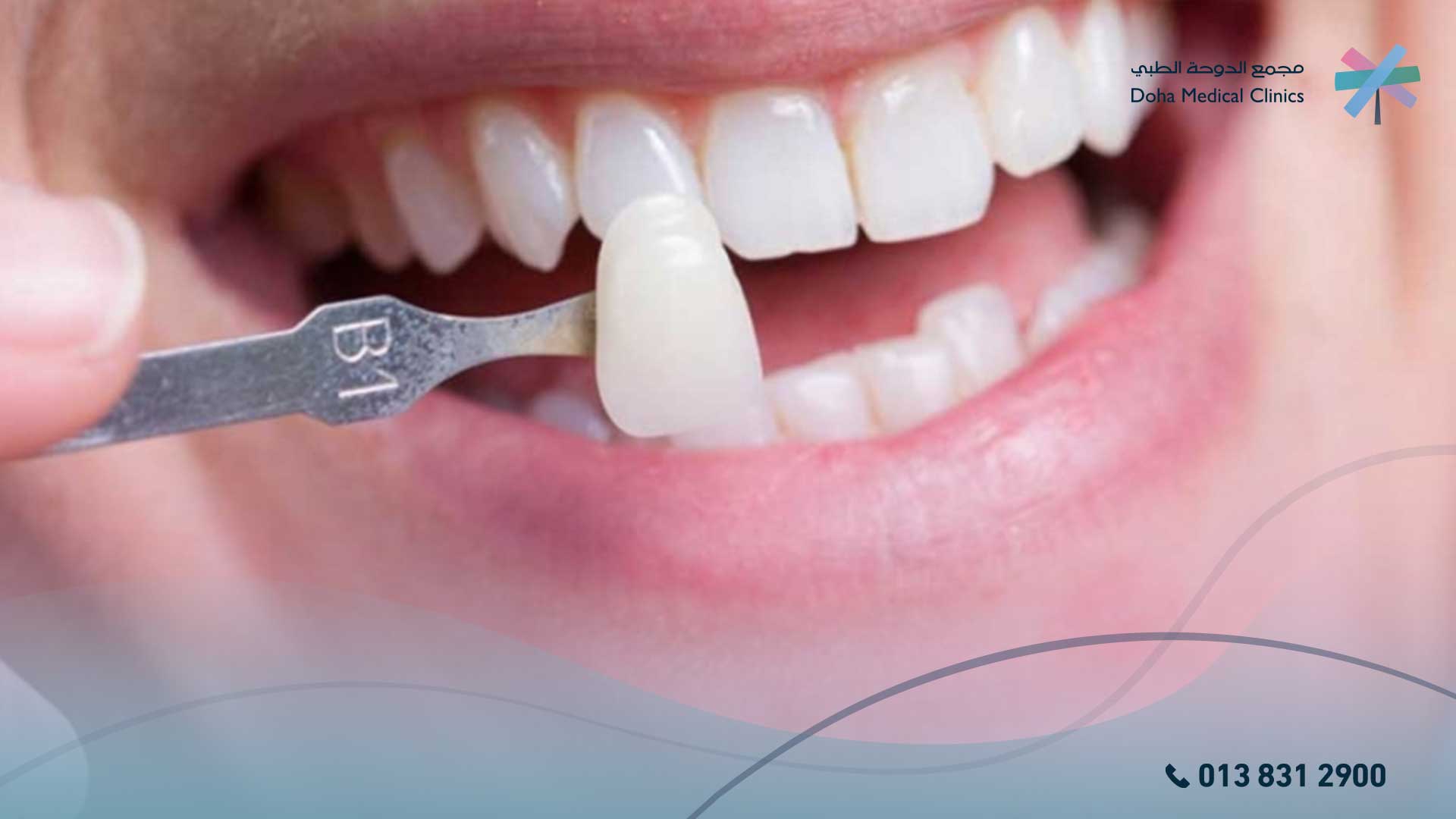 افضل أنواع الأسنان التركيب
