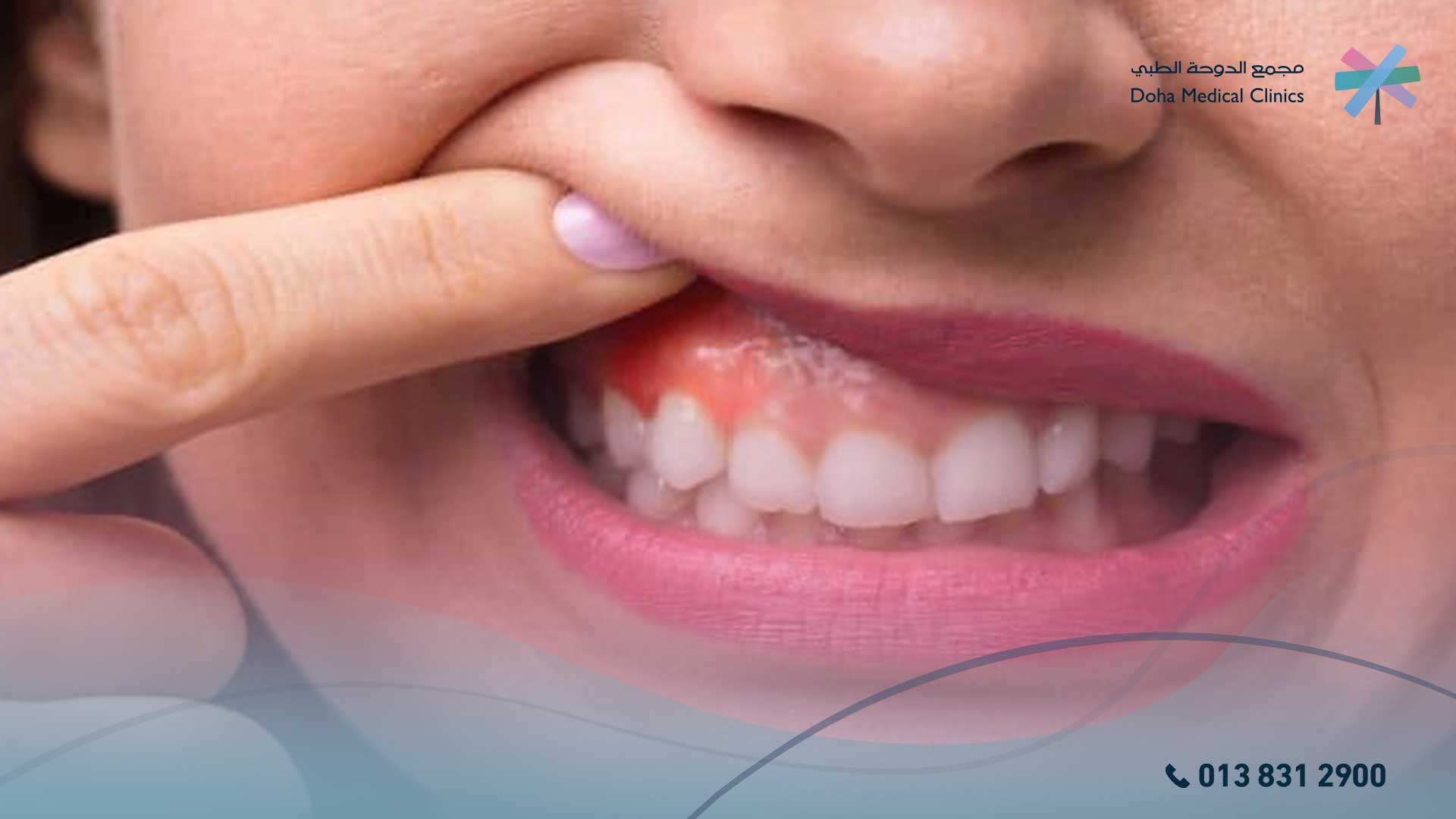 علاج التهاب اللثة وانتفاخها في المنزل