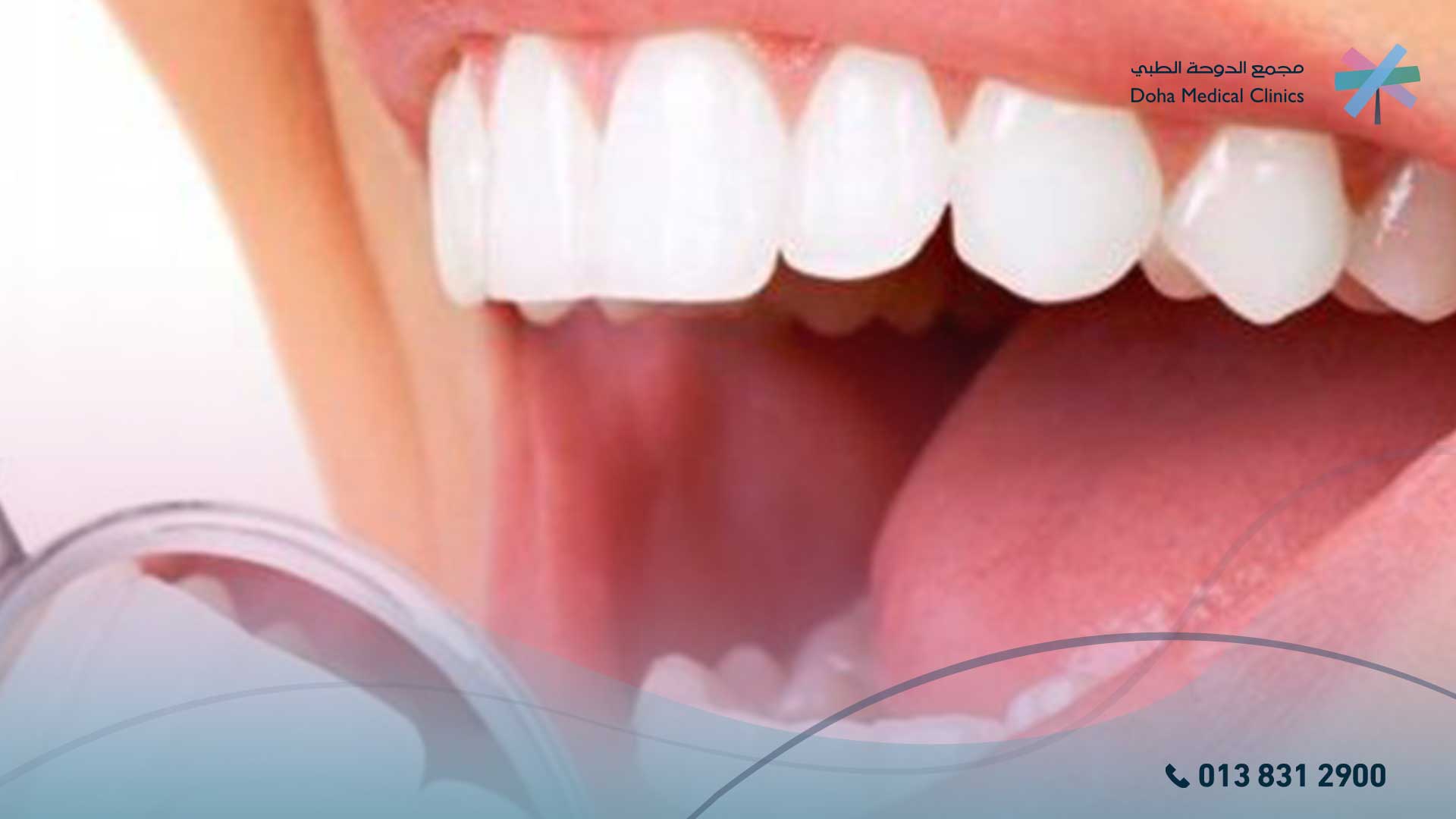 تلبيس الاسنان جاهزة التجميلي