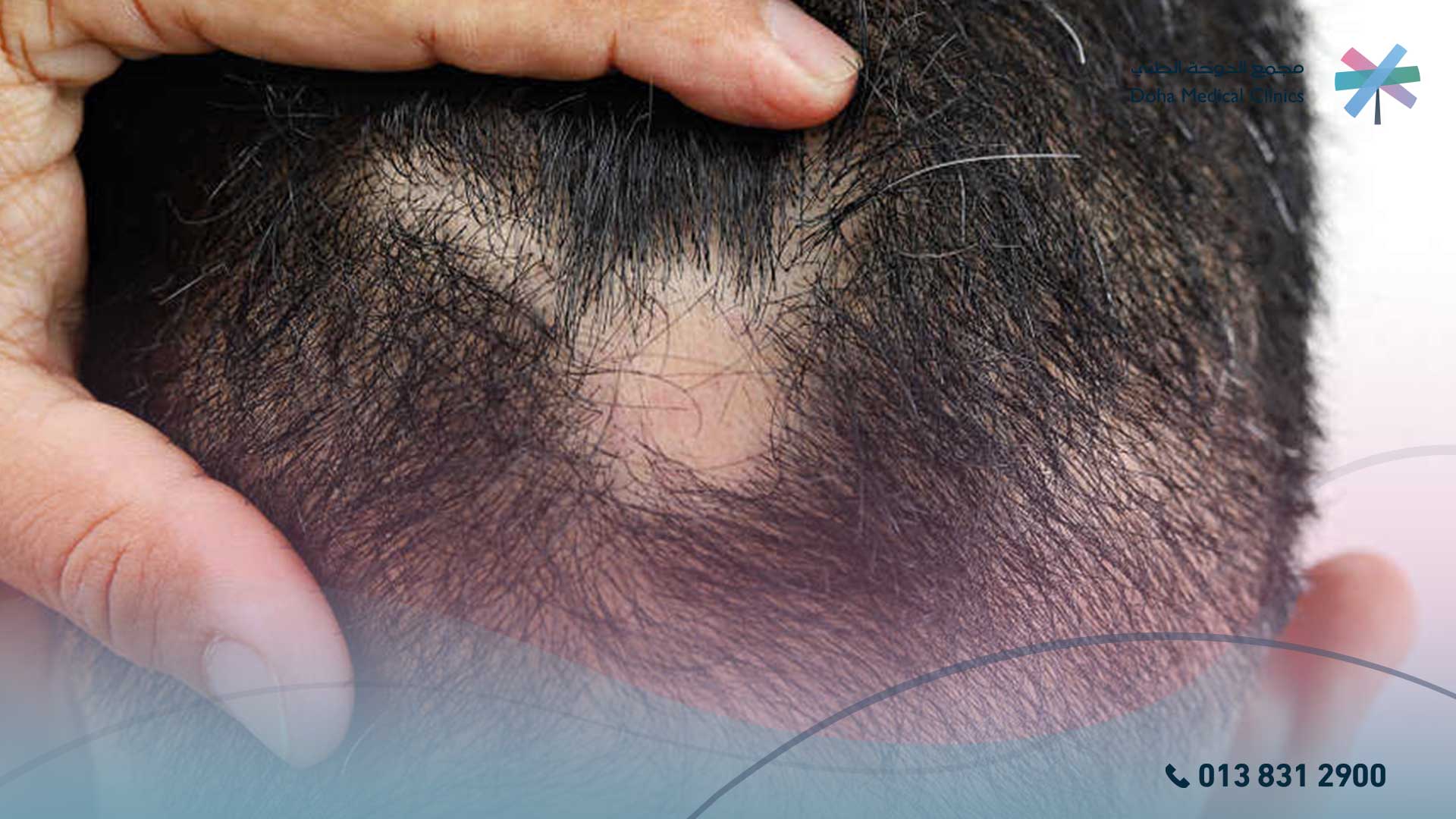 هل الحكة من اعراض الثعلبة
