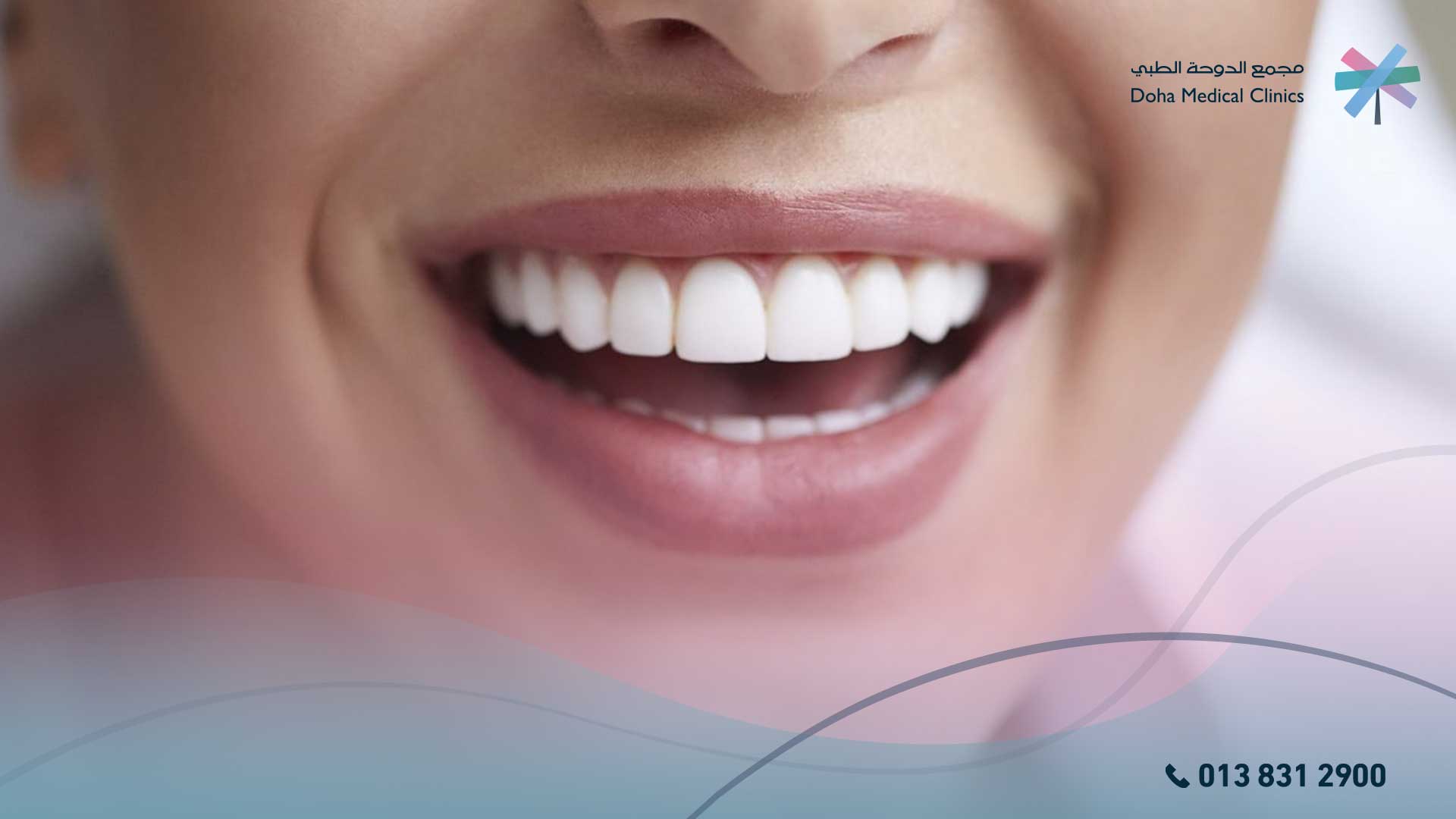 العدسات اللاصقة للاسنان