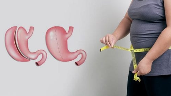 عمليات قص معده